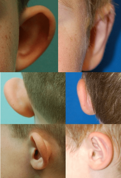 Before and after left ear otoplasty