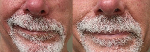 Before and after left masseteric nerve transfer