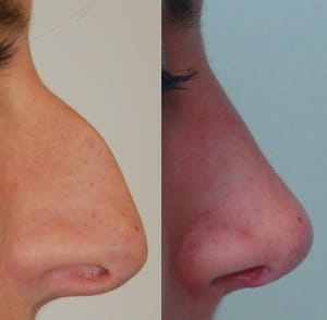 Before and after rhinoplasty 1
