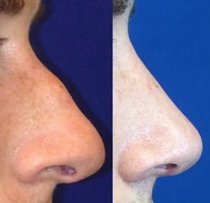 Before and after rhinoplasty 2