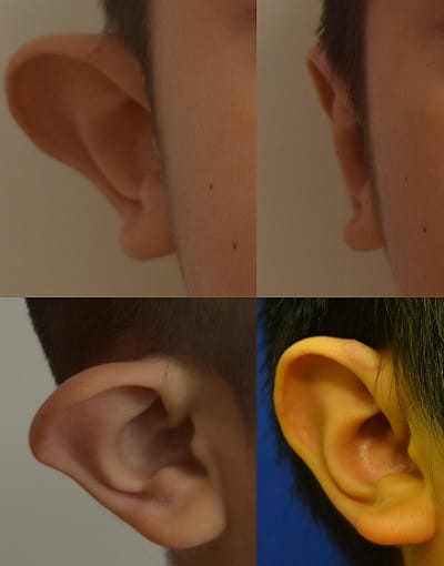 Before and after right ear otoplasty