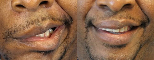 Before and after right massteric nerve transfer