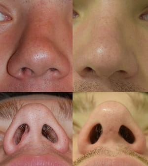 Before and after septorhinoplasty 1