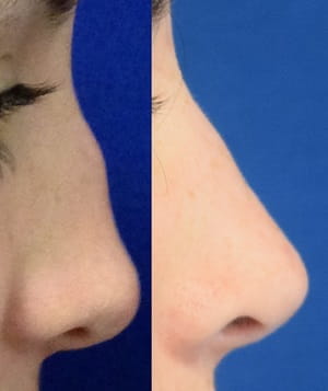 Before and after septorhinoplasty 2