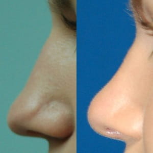 Before and after tip rhinoplasty 1