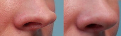 Before and after tip rhinoplasty 2