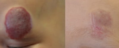 Eyebrow hemangioma laser treatment