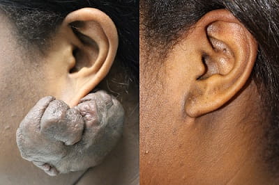 Keloid before and after surgical removal 1