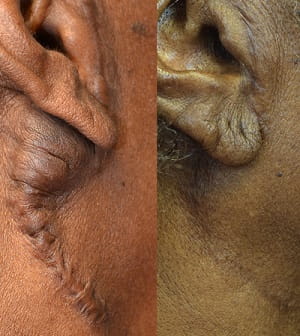 Keloid before and after surgical removal 2