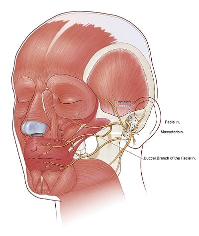 Masseteric nerve transfer drawing