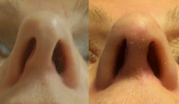 Nasal valve collapse before and after surgery