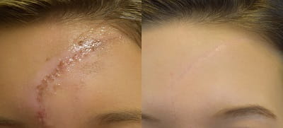 Scar before and after dermabrasion and laser