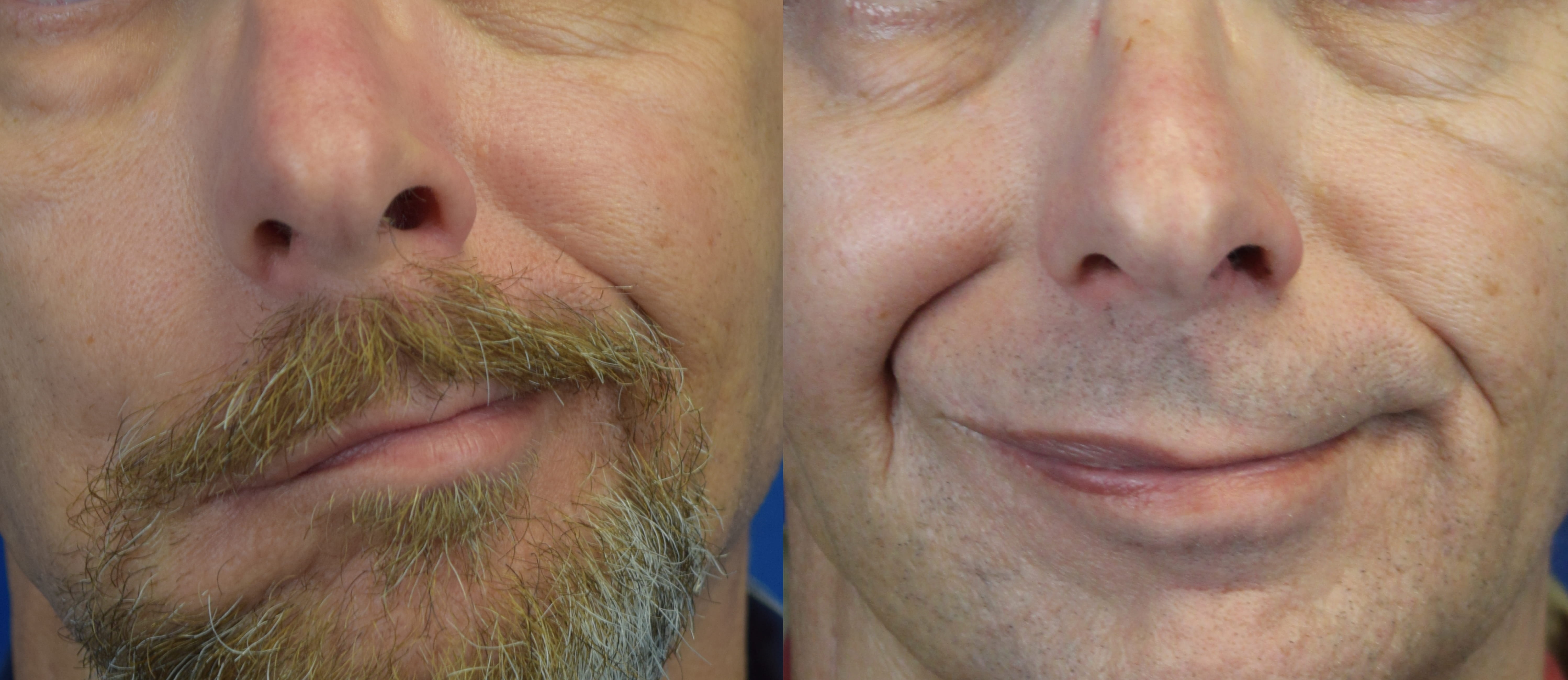 Smile before and after temporalis tendon transfer