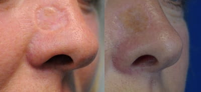 Before and after repair of nasal defect by skin graft