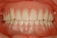 Removable Prosthesis Overdenture