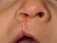 Unilateral Cleft