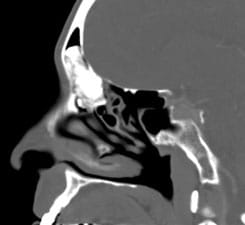 A large osteoma fills the frontal sinus. This was removed endoscopically
