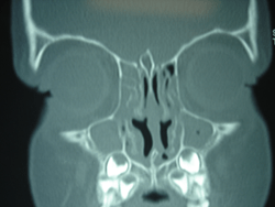 Computed tomography CT scan showing chronic rhinosinusitis in a child