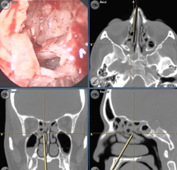 Computer guidance during sinus surgery