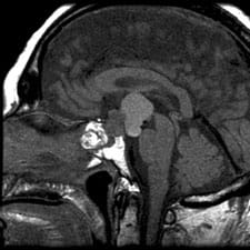MRI of a craniopharyngioma above pituitary gland. 