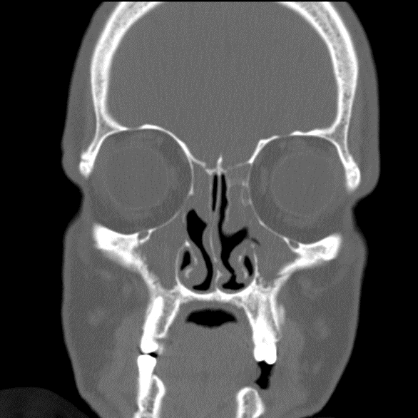 CT scan showing chronic rhinosinusitis in patient with CF