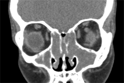 CT scan showing complete blockage of all sinuses in patient with AERD