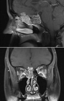 An esthesioneuroblastoma extending into the brain of a patient.