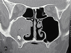 Fungal ball in right maxillary sinus