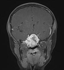 A Juvenile Nasopharyngeal Angiofibroma (JNA) that was removed endoscopically