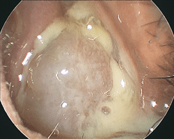 Large polyp with surrounding thick secretions indicating active infection