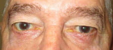 Lower eyelids have been lengthened with surgery