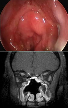 Endoscopic view and MRI after complete resection of esthesioneuroblastoma.