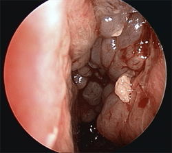 Sinusitis Medical Services Services Musc Health Charleston Sc