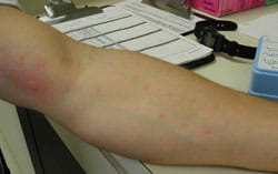 Red and swollen upper arm typical with positive allergy test.