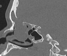 Sagittal CT with a large segment of missing bone and an encephalocele herniating down into nose.