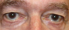 Shortened lower eyelids before surgery