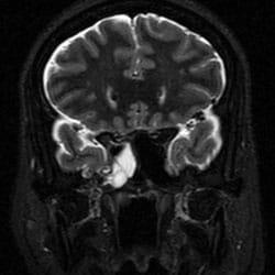 MRI scan showing spinal fluid (bright) leaking from brain into the sinus cavity