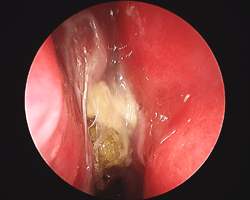 Thick mucus drainage in right nasal cavity