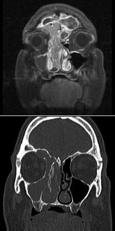 MRI and CT of an inverted papilloma that eroded into the eye and brain was removed endoscopically 