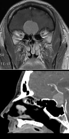 CT and MRIs demonstrating various meningiomas that have been removed endoscopically.