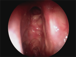 Widely open sinuses in patient 3 months after sinus surgery