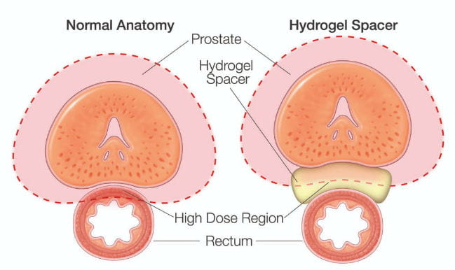 Illustration of normal anatomy next to hydrogel spacer. Attribution: Memorial Sloan Cancer Center.