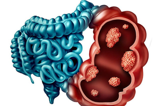 Illustration of intestinal cancer.