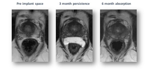 A series of three MRI images showing pre-implant space, three month persistence, and six month absorption of hydrogel.