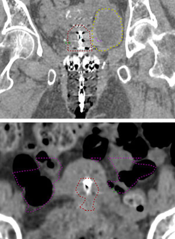 Brachytherapy has been traditionally prescribed to point A (top, indicated in green), a standard point 2 cm above and to the side of the ovoids. Prescribing to Point A can overestimate tumor size. For example, Point A is located in the bladder (top, yellow dotted line) and small bowel (bottom, purple dotted line) in these images. The red dotted line is the target volume.