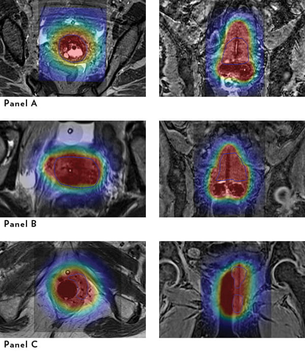 Magnetic Resonance Planning Images for High-Dose-Rate Brachytherapy
