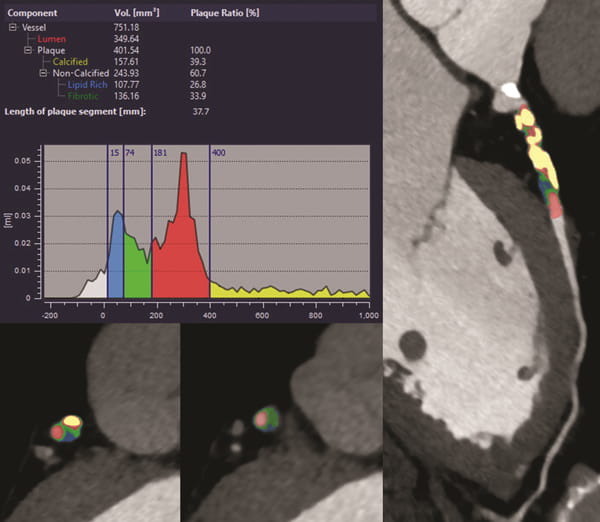 Quantitative imaging of coronary atherosclerotic plaque.