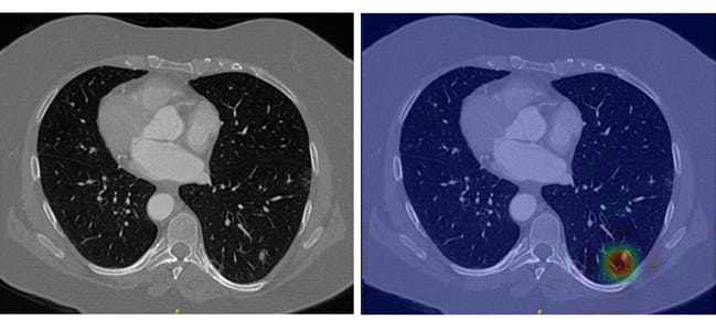 Lung nodules in an unaltered CT scan require sharp eyes for detection (left), but LungWeb highlights suspicious areas to make detection much less labor intensive (right).