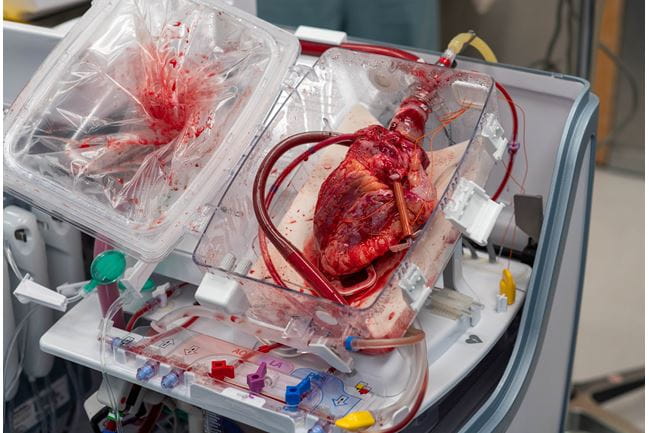 Donor heart on perfusion machine