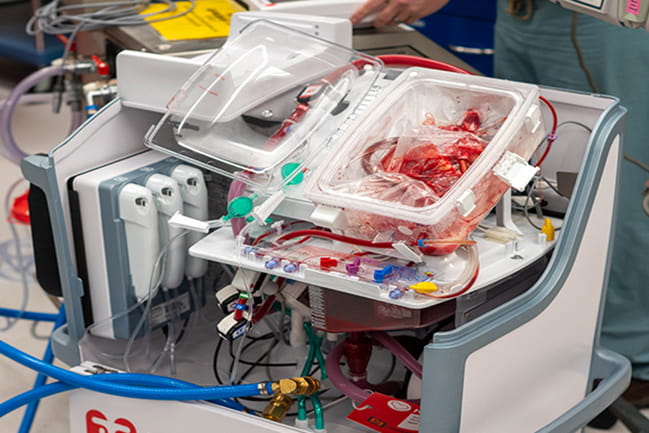 Donor heart in perfusion machine